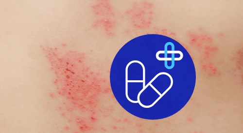 We can treat Shingles